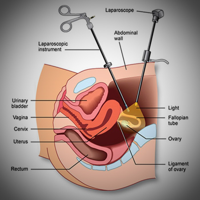 best Gynecological Laparoscopic Surgery Hospital in Mandi HP