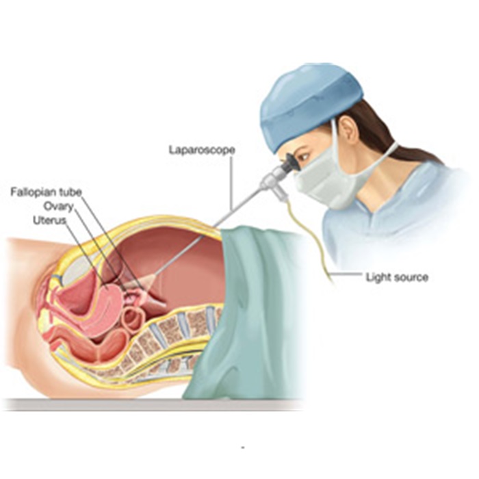 Gynecological Laparoscopic Surgery Hospital in mandi HP